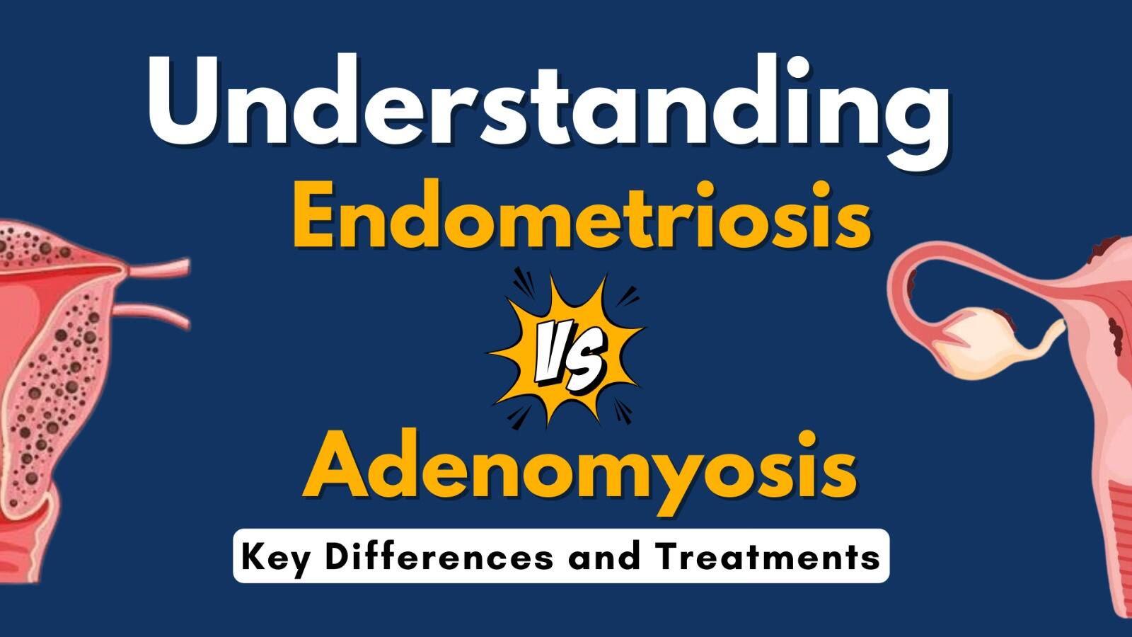 Understanding Endometriosis vs. Adenomyosis: Key Differences and ...